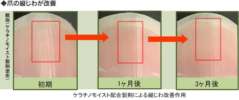 ケラチノモイスト配合製剤による爪の縦ジワ改善作用。無塗布と比較して改善が見られた。