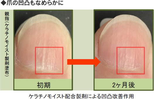 ケラチノモイスト配合製剤による凹凸改善作用。爪の凹凸の改善が見られた。