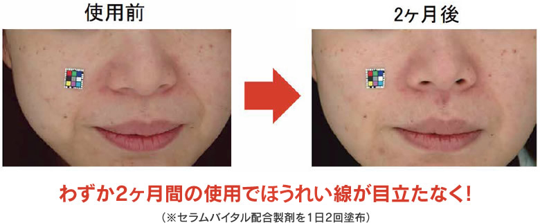 セラムバイタル配合製剤のヒト試験の結果。ほうれい線が目立たなくなった。