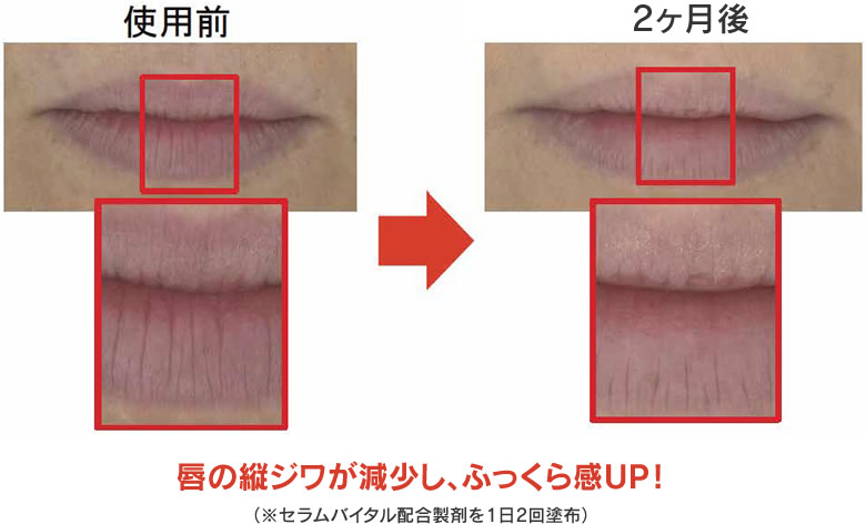 セラムバイタル配合製剤でのヒト試験の結果。唇の縦ジワが改善された。