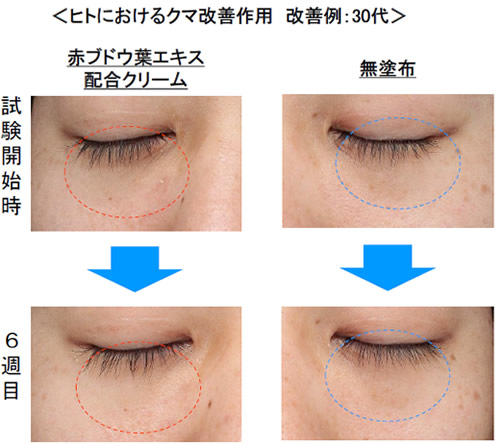 赤ブドウ葉エキス配合クリームのヒト試験。クマ改善作用がみられた
